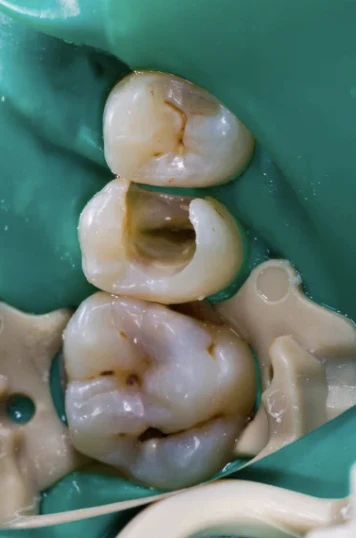 根管治療