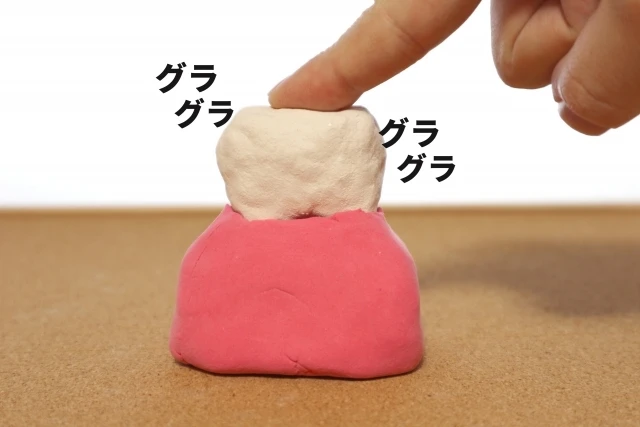 歯肉炎の予防と治療